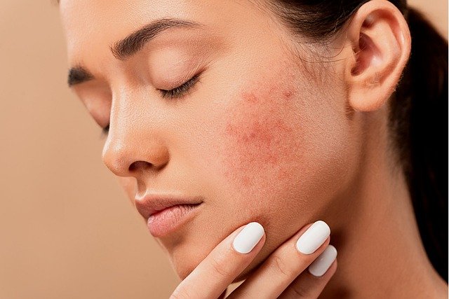 acne pimple spots
